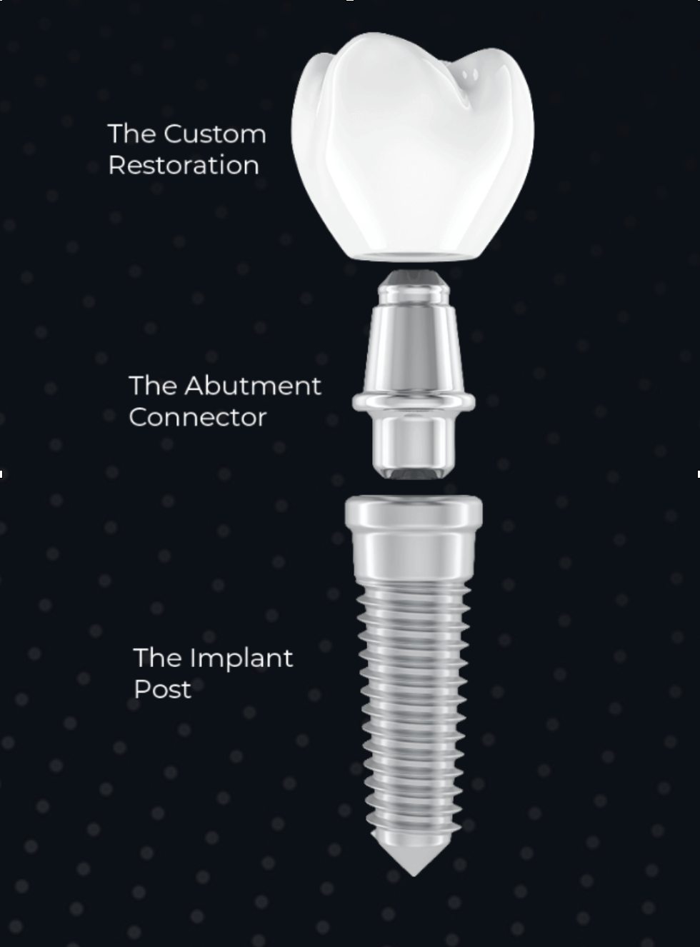 Diagram of a dental implant — the titanium implant post in the jaw, the abutment connector, and the custom restoration (crown) on top