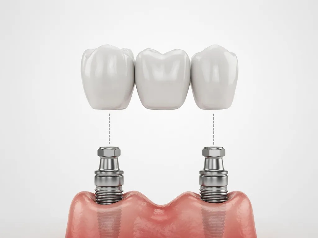 An implant-supported bridge replacing several missing teeth